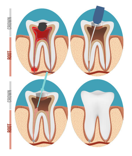 Root Canal Dentist & Treatment Colorado Springs, CO