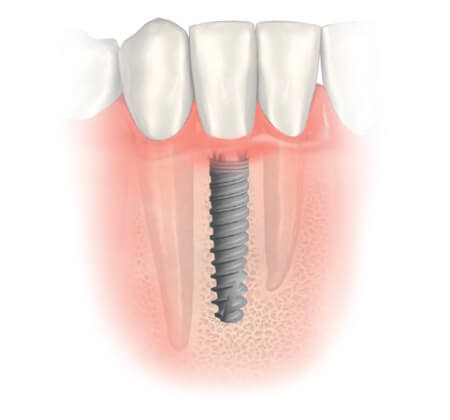 dental implants colorado springs, co