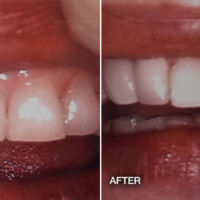 before & after cosmetic